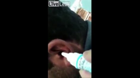 Un médecin injecte de l'eau dans l'oreille d'un patient. Ce qui en sort est  inimaginable !
