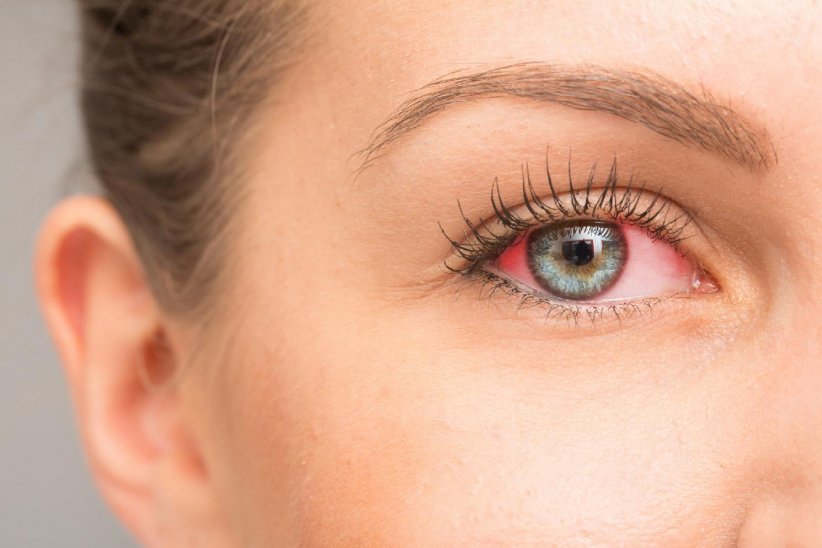 Un œil rouge chez une personne portant des lentilles Un œil rouge chez une personne portant des lentilles