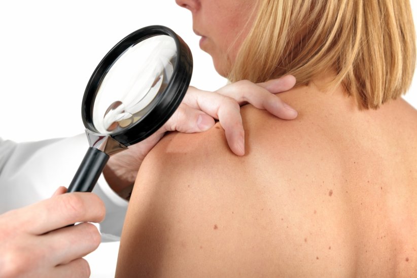 Les coups de soleil à l'origine du cancer de la peau Les coups de soleil à l'origine du cancer de la peau