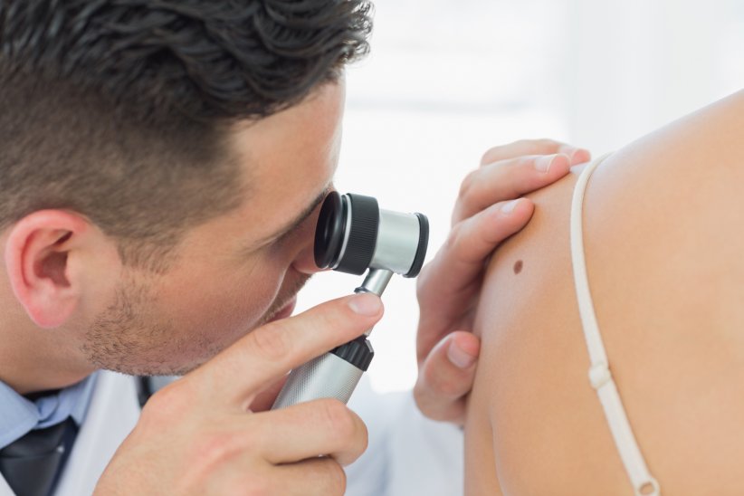 Le carcinome et le mélanome, deux cancers de la peau Le carcinome et le mélanome, deux cancers de la peau