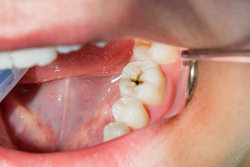 Les caries Les caries