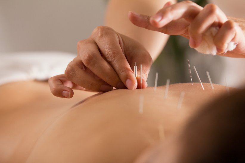 L'acupuncture : soigner par les aiguilles L'acupuncture : soigner par les aiguilles
