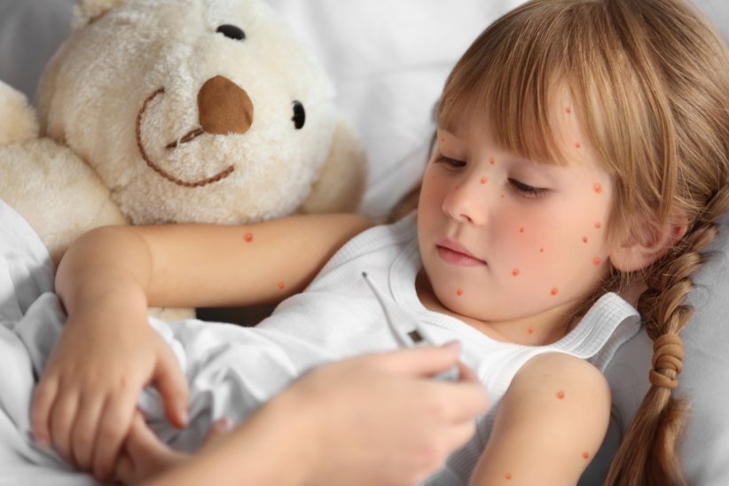 Concrètement, comment la varicelle s'attrape ? Concrètement, comment la varicelle s'attrape ?