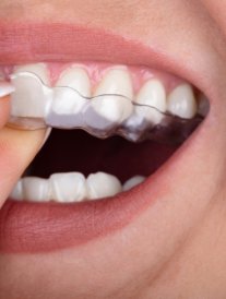 Gouttières dentaires : bonne ou mauvaise idée ?
