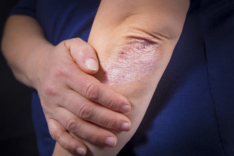 Le psoriasis, où quand la peau se détache Le psoriasis, où quand la peau se détache