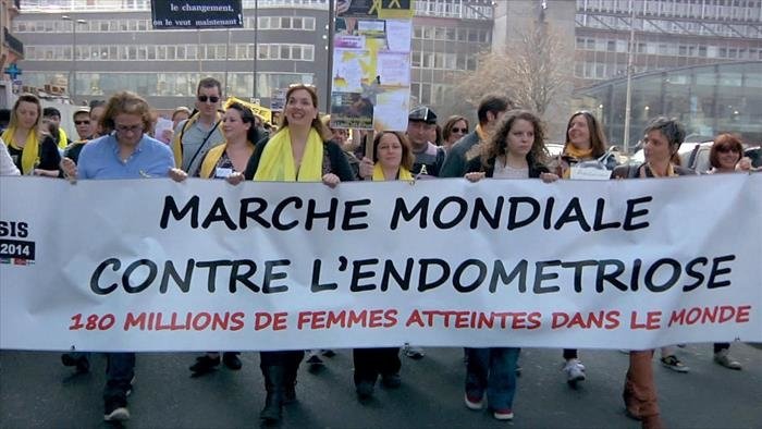 Endométriose, une maladie qui sort de l'ombre