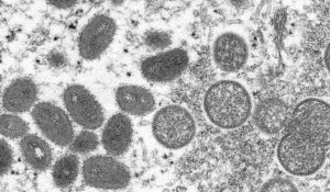 Hors Afrique, 80 cas de variole du singe recensés dans le monde