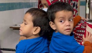 Bangladesh: des chirurgiens vont séparer des jumelles siamoises