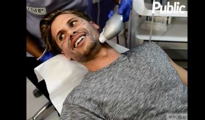 Exclu Vidéo : Benoît Dubois : "Mon lifting ? C'est pour réparer ma peau acnéique !"