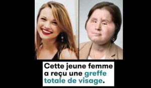 Cette jeune femme a reçu une greffe totale de visage