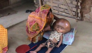 Un Indien espère un "miracle" pour sa fille hydrocéphale