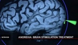 Une stimulation magnétique du cerveau contre l'anorexie