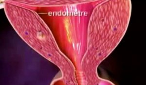 Une étudiante de 28 ans est décédée d'un cancer du col de l'utérus, diagnostiqué seulement 9 mois après son frottis