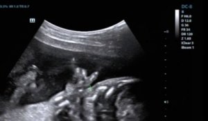 Ce bébé fait le signe Rock de la main dans le ventre de sa mère ! Echographie