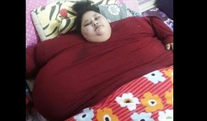 La femme la plus grosse du monde a perdu 100 kilos après une opération chirurgicale associée à un régime