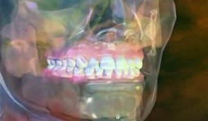 La dévitalisation d'une dent expliquée en vidéo