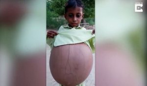 Ce jeune Pakistanais de 9 ans avec le ventre hyper gonflé attend une opération pour lui sauver la vie
