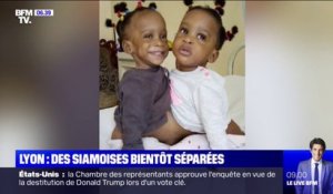 Deux sœurs siamoises d'un an seront séparées le 7 novembre prochain à Lyon