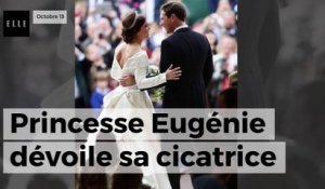 Princesse Eugénie : en dévoilant sa cicatrice, elle veut « changer notre vision de la beauté »