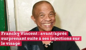 Francky Vincent : avant/après surprenant suite à ses injections sur le visage