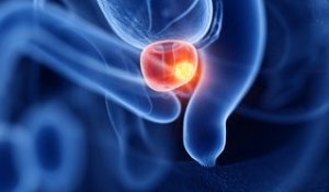 "Le dépistage organisé du cancer de la prostate : quelles raisons expliquent son absence ?
