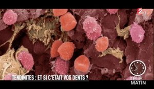 Santé - Tendinites : et si c’était vos dents ? - 2016/02/24