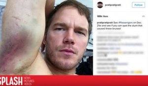 Chris Pratt montre les bleus qu'il s'est fait durant le tournage de Passengers