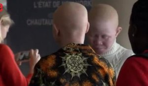 Tanzanie: quatre enfants albinos vont se faire soigner aux États-Unis