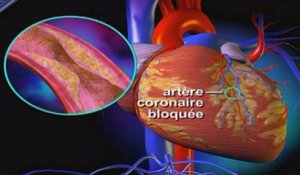 L'angiographie expliquée en vidéo