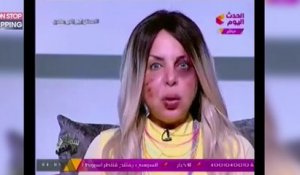 Battue par son mari, une présentatrice égyptienne anime son émission le visage "tuméfié" (Vidéo)