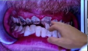 20 ans sans se brosser les dents, son dentiste découvre la catastrophe