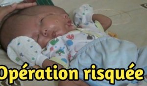 Naissance en Indonésie d'un bébé avec une malformation crâniofaciale et une duplication cérébrale