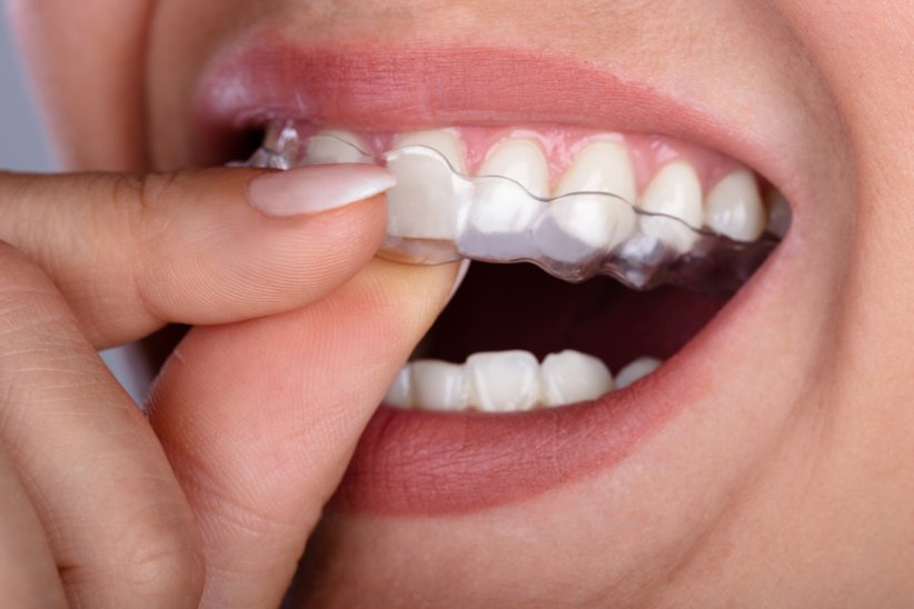 Si les gouttières dentaires sont efficaces pour aligner les dents, elles ne conviennent pas à tout le monde !